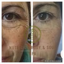 Antes y después de tratamiento facial