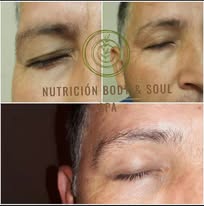 Resultado facial perfil antes y después